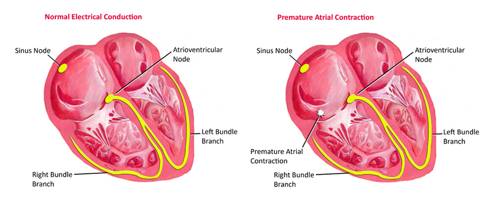 Premature ventricular contractions